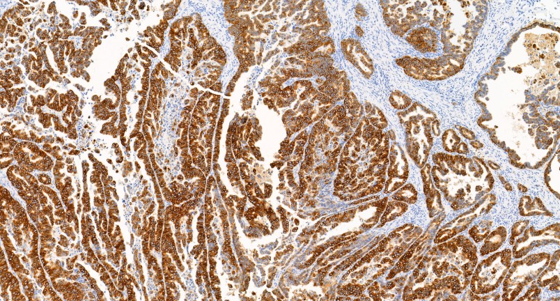 Breast cancer biomarker profiling