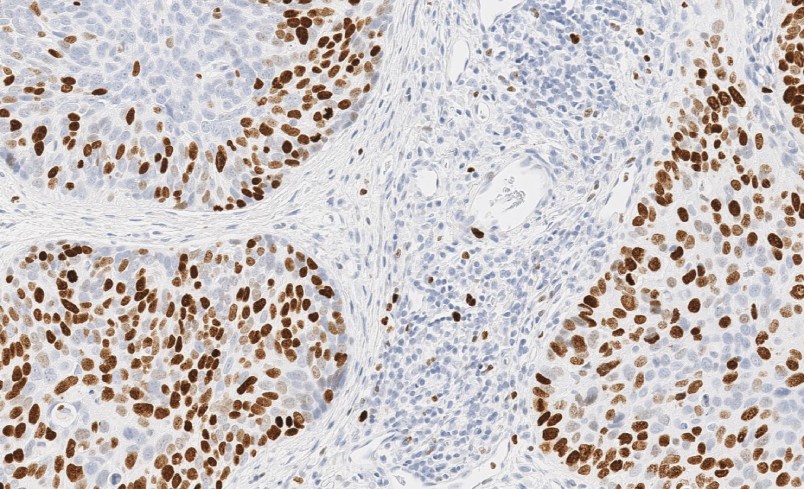 Lupus anti-dsDNA antibody complement C3 B T lymphocyte monitoring