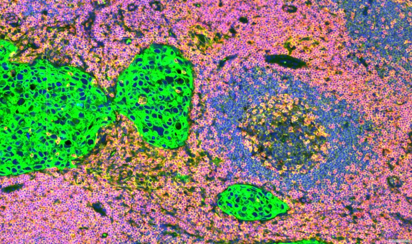 Ovarian cancer spatial TME profiling