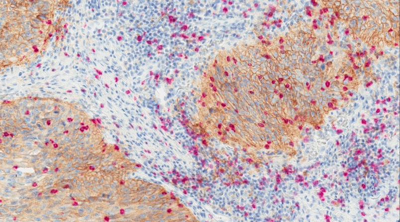 Parkinson’s Disease biomarker discovery