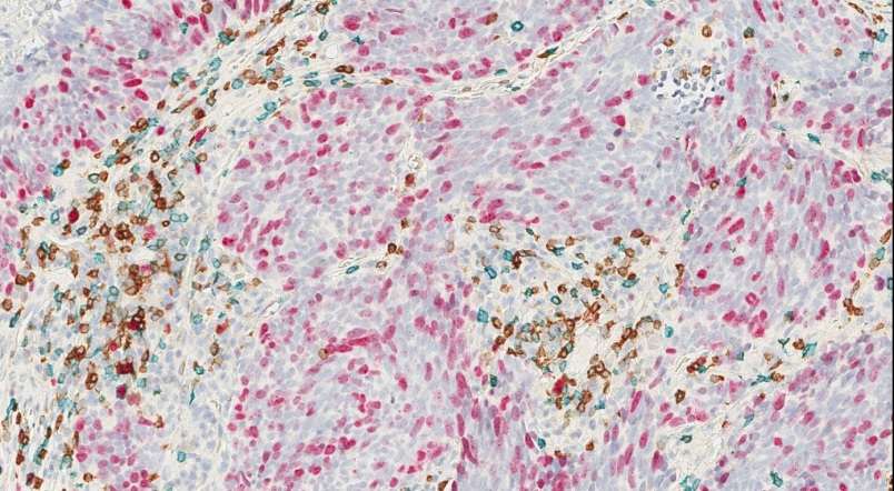 Urothelial cancer CDx support