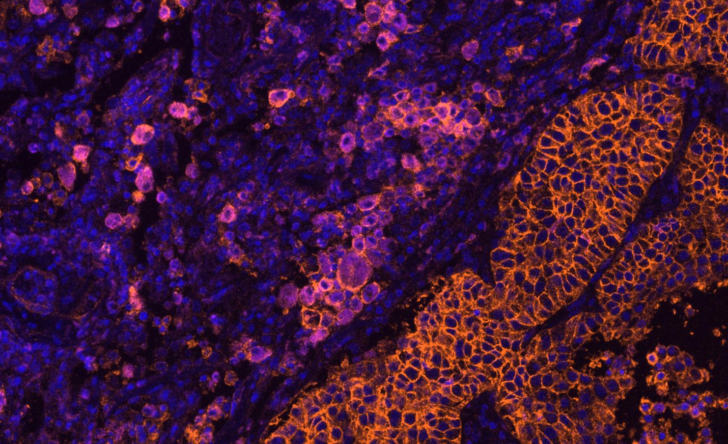 Multiplex immunofluorescence image of tumor tissue stained for CD8, PD-1, PD-L1 and CD68 immune markers.